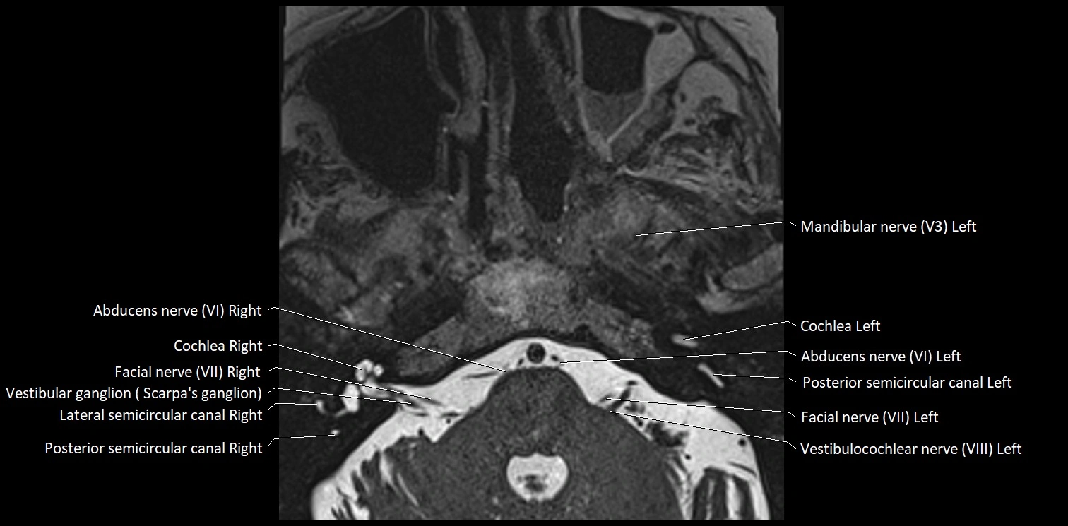 Cranial nerve anatomy axial MRI 3T image 57.webp